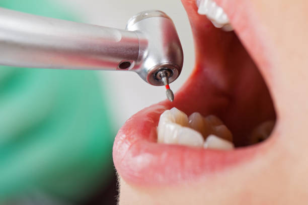 Best Emergency Wisdom Teeth Removal in Fruitvale, CO